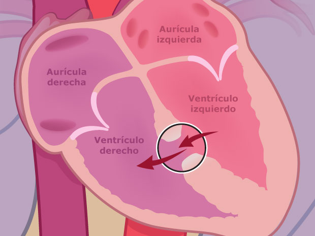 Este agujero permite que parte de la sangre procedente del ventrículo izquierdo retroceda hacia el ventrículo derecho en lugar de salir del corazón a través de la aorta.