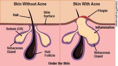 Views below the surface show skin with and without acne.