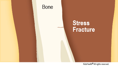 Diagram showing a thin stress fracture in a bone.