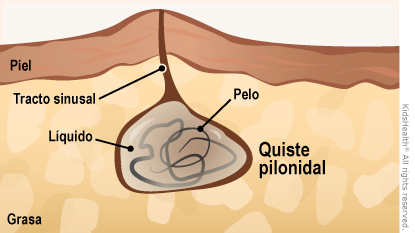 Corte transversal que muestra un quiste pilonidal lleno de líquido y pelo, debajo de la piel, con un tracto sinusal.