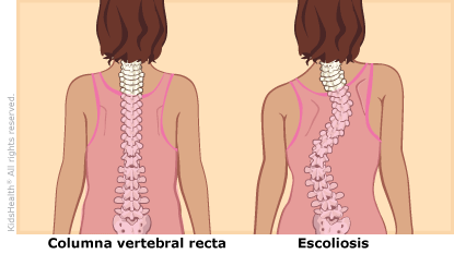 illustration: scoliosis