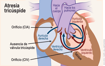 Se muestra un corte transversal del corazón con atresia tricúspide: un defecto congénito en el que falta la válvula tricúspide y hay dos orificios en el tabique que provocan un flujo sanguíneo mal dirigido.